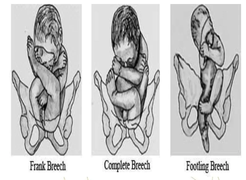 breech presentation risks